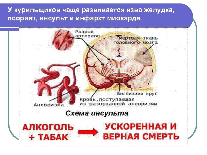 У курильщиков чаще развивается язва желудка, псориаз, инсульт и инфаркт миокарда. 