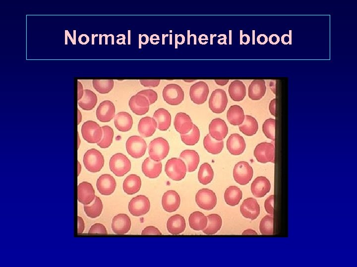 Normal peripheral blood 