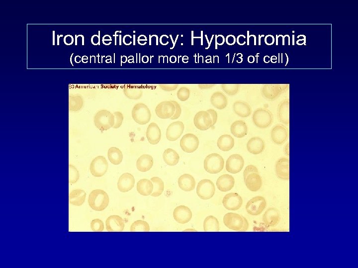 Iron deficiency: Hypochromia (central pallor more than 1/3 of cell) 
