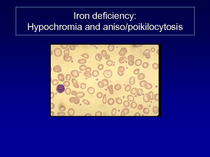 Iron deficiency: Hypochromia and aniso/poikilocytosis 