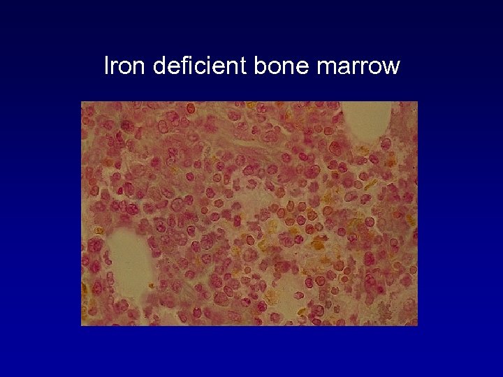 Iron deficient bone marrow 