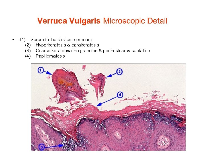 Verruca Vulgaris Microscopic Detail • (1) Serum in the stratum corneum (2) Hyperkeratosis &