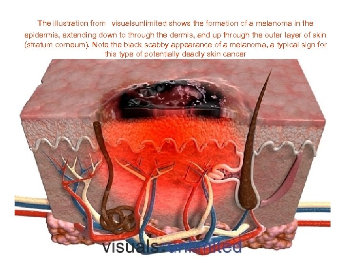  The illustration from visualsunlimited shows the formation of a melanoma in the epidermis,