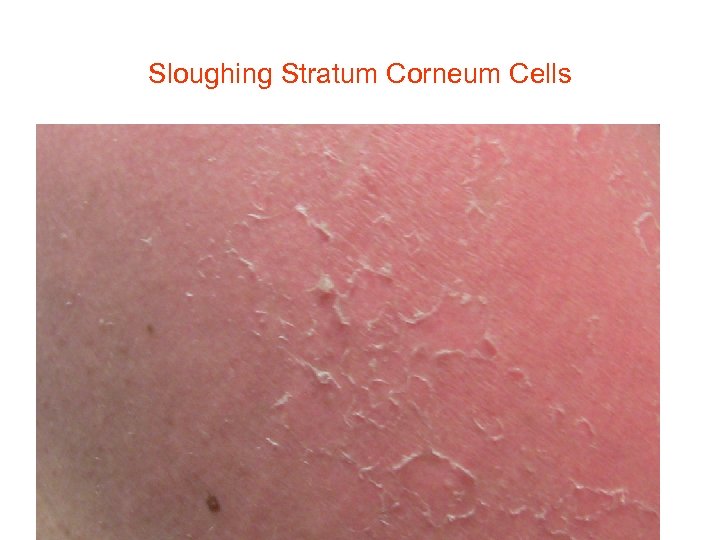 Sloughing Stratum Corneum Cells 