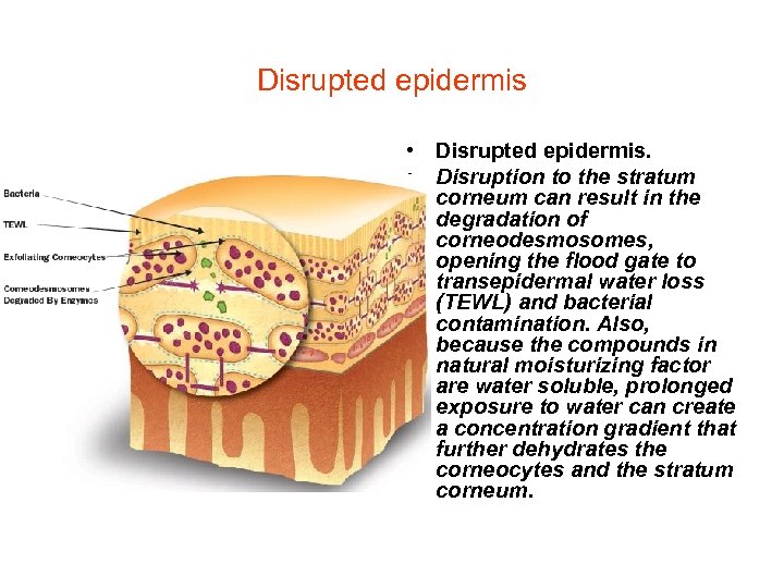 Disrupted epidermis • Disrupted epidermis. • Disruption to the stratum corneum can result in