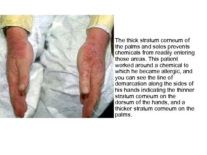  • The thick stratum corneum of the palms and soles prevents chemicals from