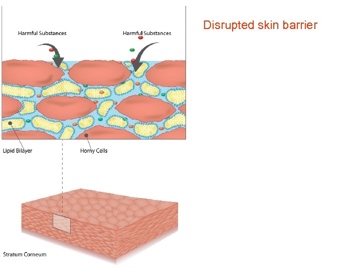  Disrupted skin barrier 