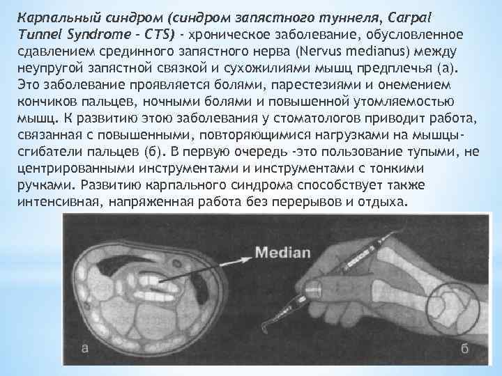 Синдром карпального канала мкб 10. Синдром на карпальный туннель. Карпальный синдром запястья УЗИ. Синдром карпального канала на УЗИ. Карпальный туннельный синдром на УЗИ.
