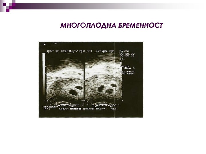 МНОГОПЛОДНА БРЕМЕННОСТ 