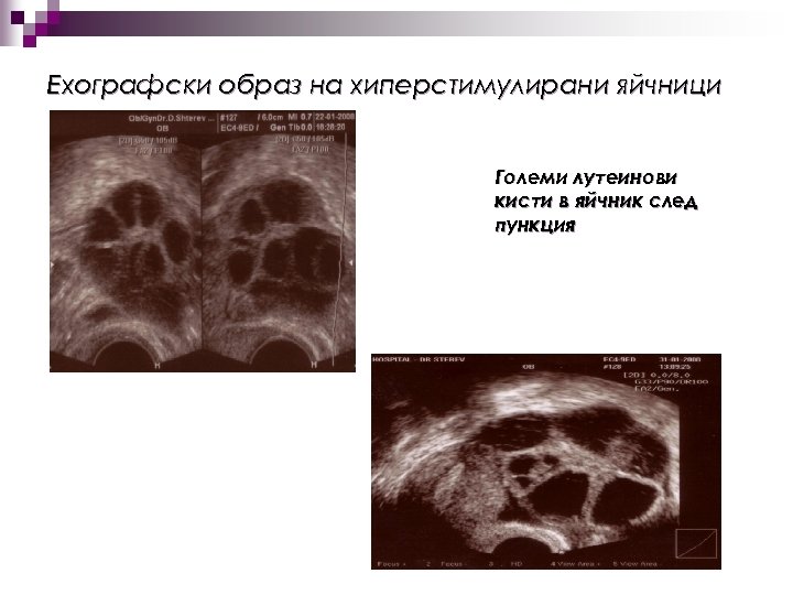 Ехографски образ на хиперстимулирани яйчници n n Големи лутеинови кисти в яйчник след пункция