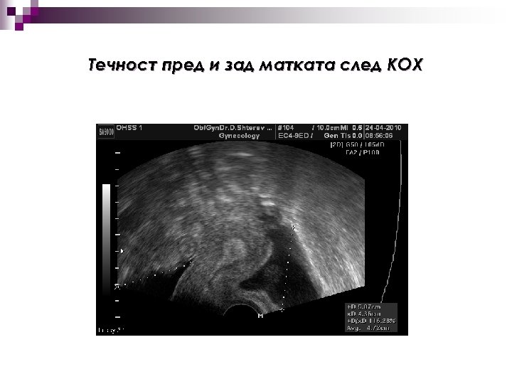 Течност пред и зад матката след КОХ 