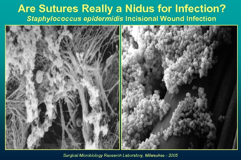 Are Sutures Really a Nidus for Infection? Staphylococcus epidermidis Incisional Wound Infection Surgical Microbiology