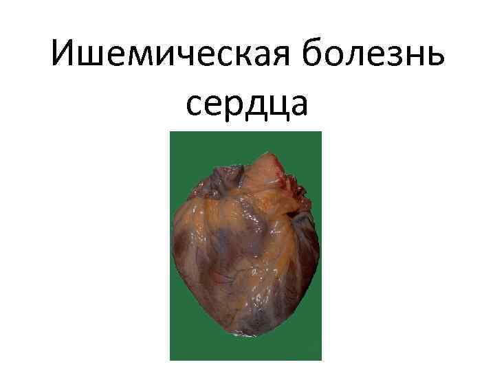 Ишемическая болезнь сердца 