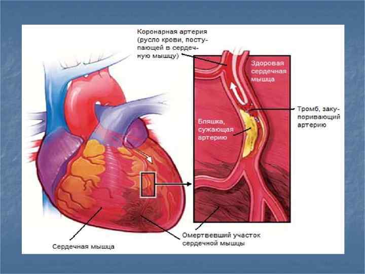 Ишемическая болезнь сердца Ишемия син местноемалокровие