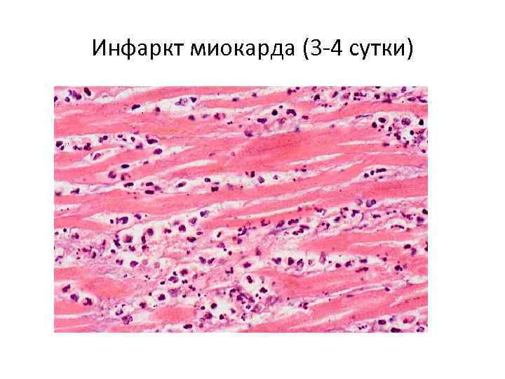 Инфаркт миокарда (3 -4 сутки) 