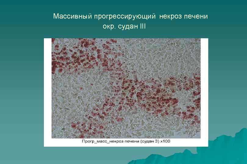  Массивный прогрессирующий некроз печени окр. судан III 