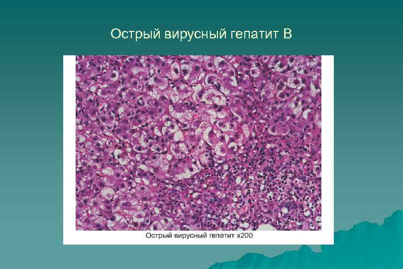 Острая дистрофия печени