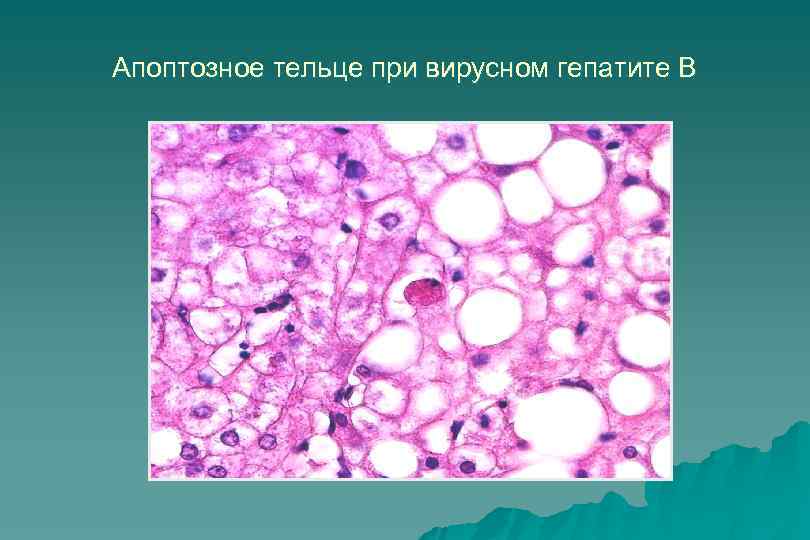 Апоптозное тельце при вирусном гепатите В 