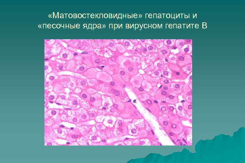  «Матовостекловидные» гепатоциты и «песочные ядра» при вирусном гепатите В 