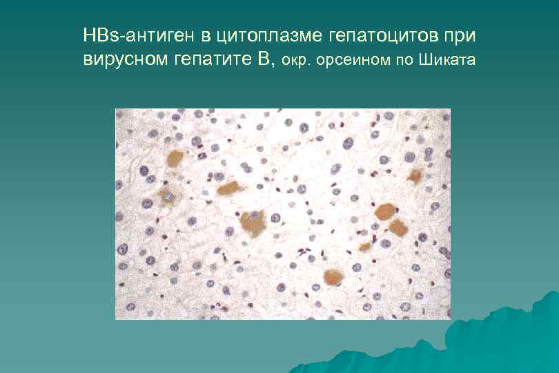 HBs-антиген в цитоплазме гепатоцитов при вирусном гепатите В, окр. орсеином по Шиката 