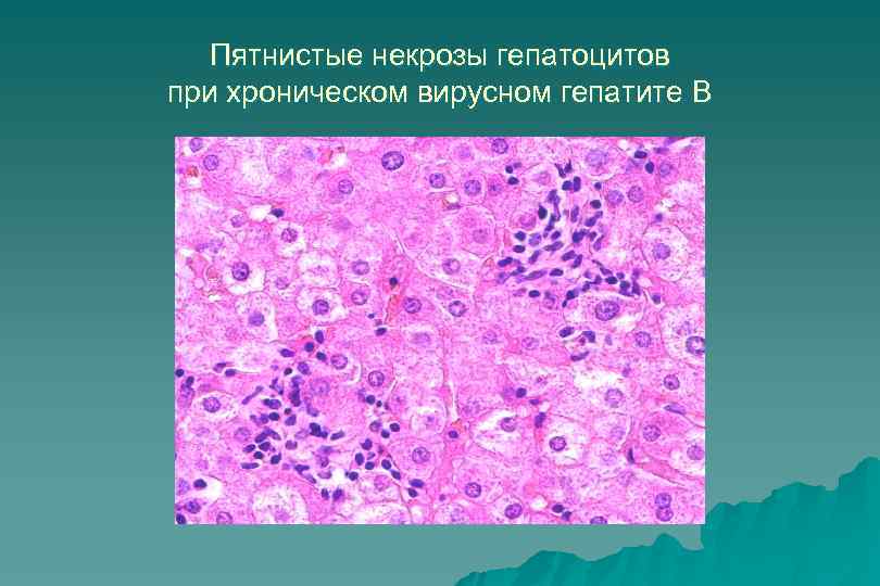 Пятнистые некрозы гепатоцитов при хроническом вирусном гепатите В 