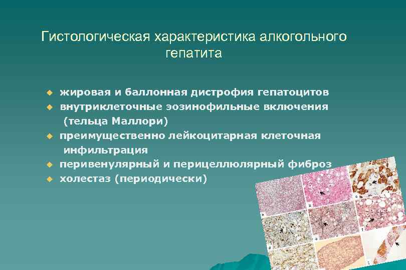 Гистологическая характеристика алкогольного гепатита u u u жировая и баллонная дистрофия гепатоцитов внутриклеточные эозинофильные