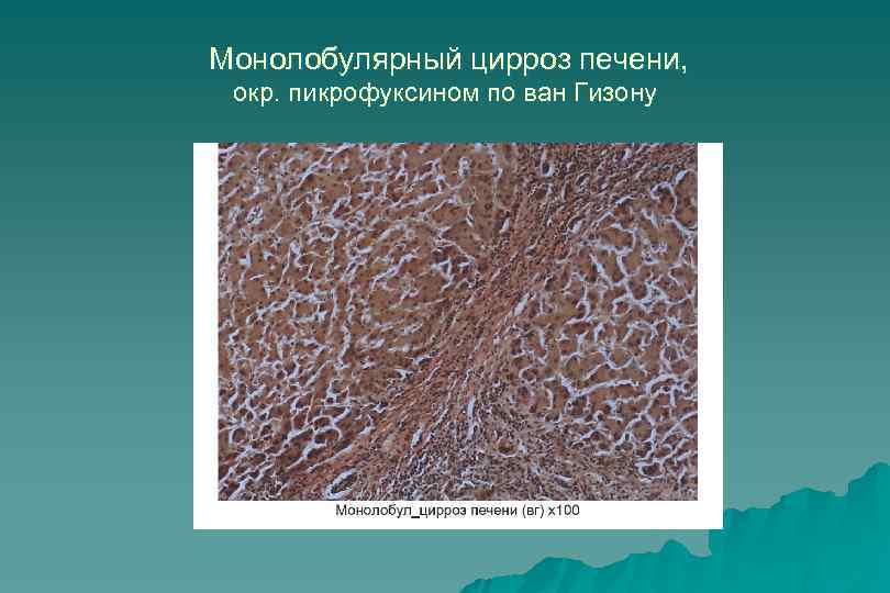  Монолобулярный цирроз печени, окр. пикрофуксином по ван Гизону 