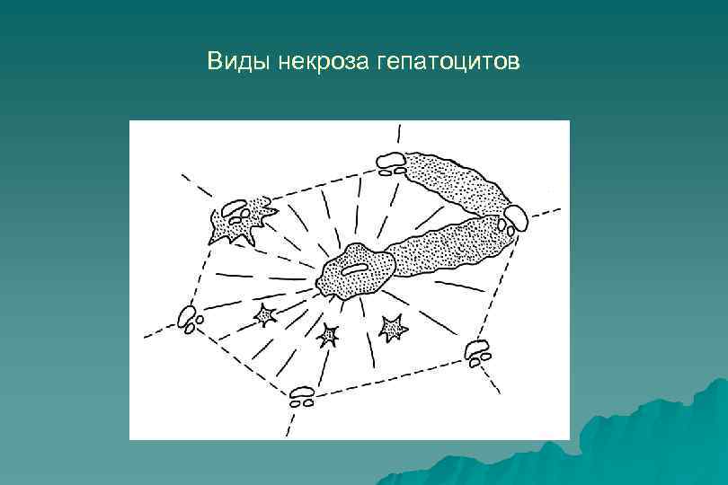 Виды некроза гепатоцитов 