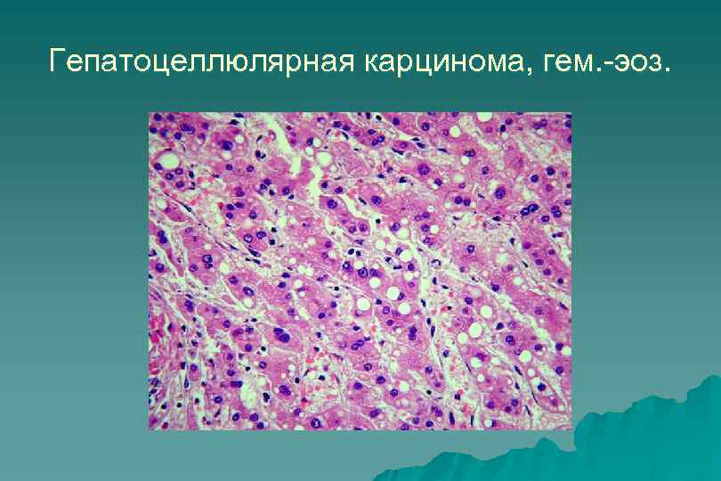 Гепатоцеллюлярная карцинома, гем. -эоз. 