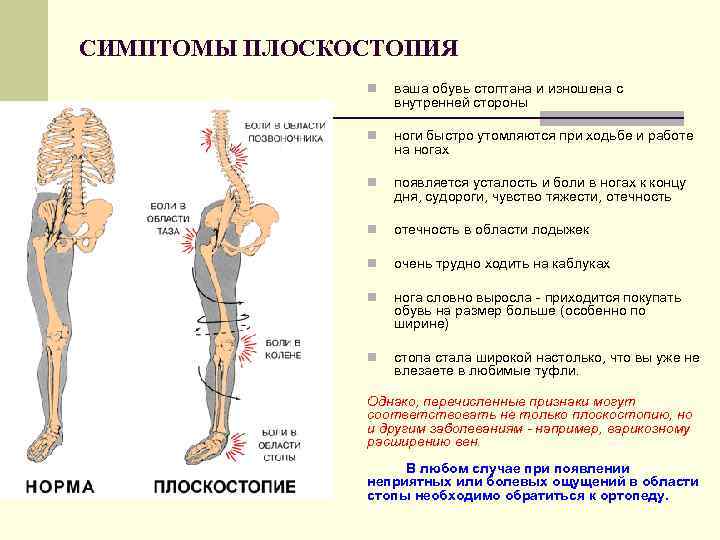 Плоскостопие симптомы. Признаки плоскостопия. Плоскостопие причины симптомы. Плоскостопие это заболевание опорно-двигательного аппарата. Симптомы плоскостопия взрослого человека.