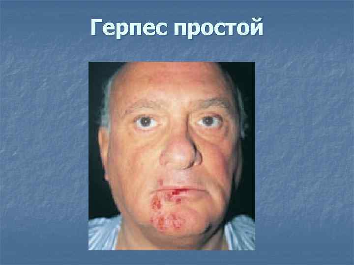 Герпес простой 