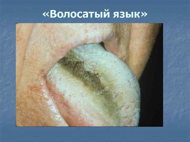  «Волосатый язык» 