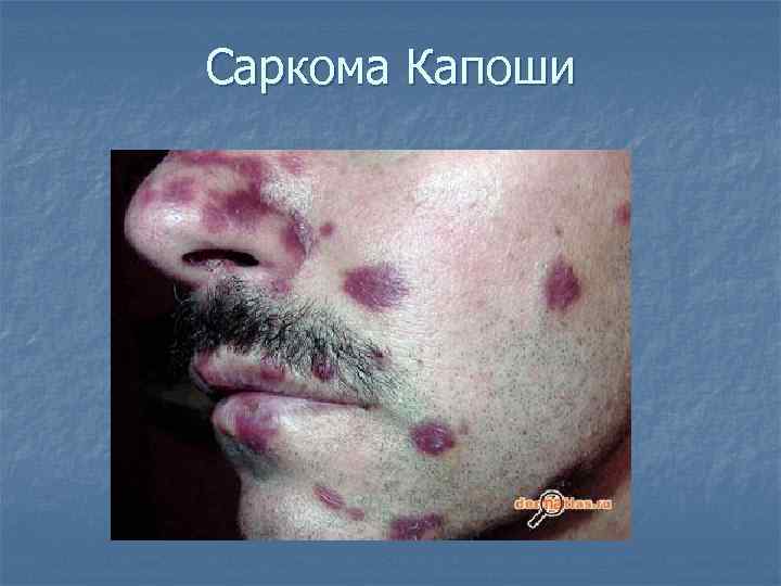 Саркома Капоши 