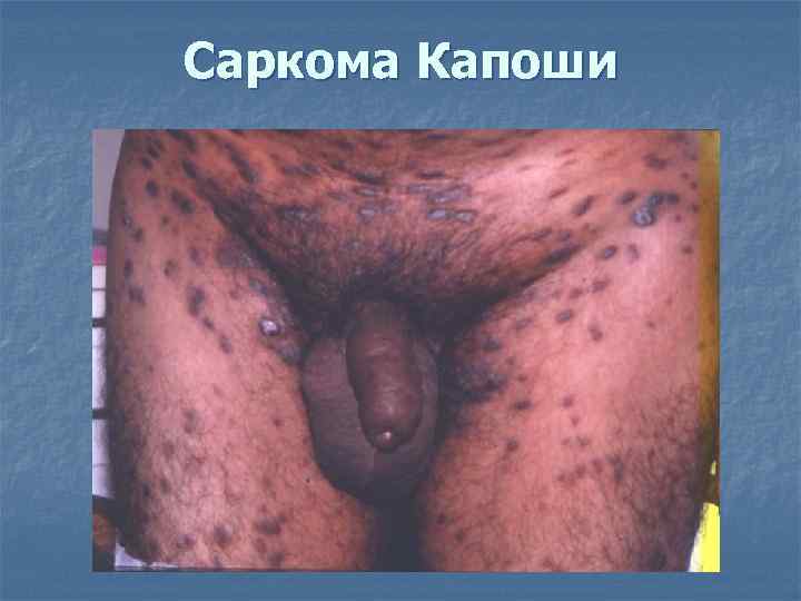 Саркома Капоши 