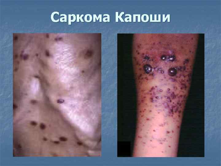 Саркома Капоши 