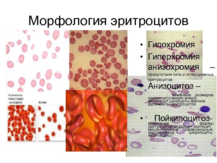 Анизоцитоз в общем анализе крови