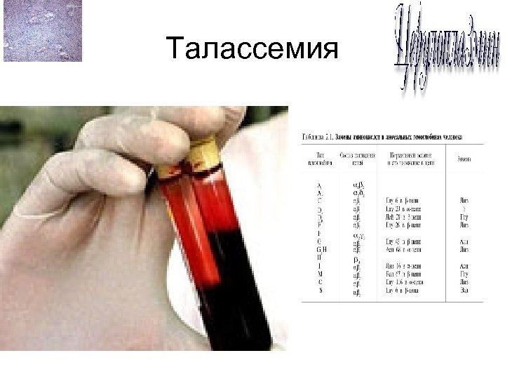 Талассемия 