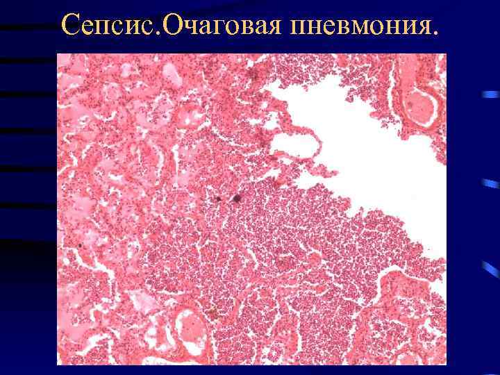 Сепсис. Очаговая пневмония. 