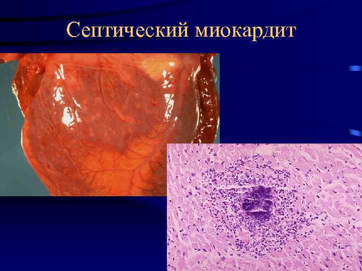 Септический миокардит 