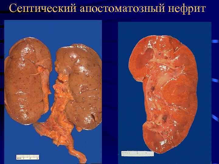 Септический апостоматозный нефрит 