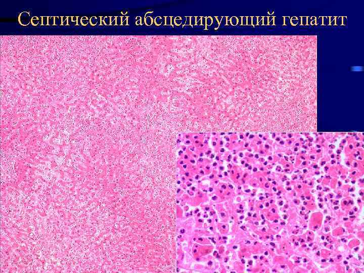 Септический абсцедирующий гепатит 