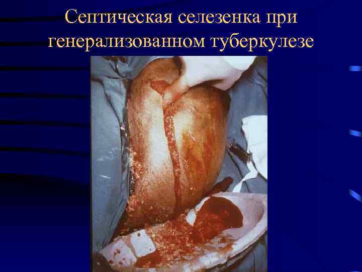 Септическая селезенка при генерализованном туберкулезе 