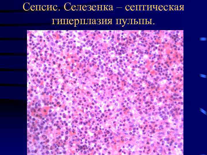 Сепсис. Селезенка – септическая гиперплазия пульпы. 