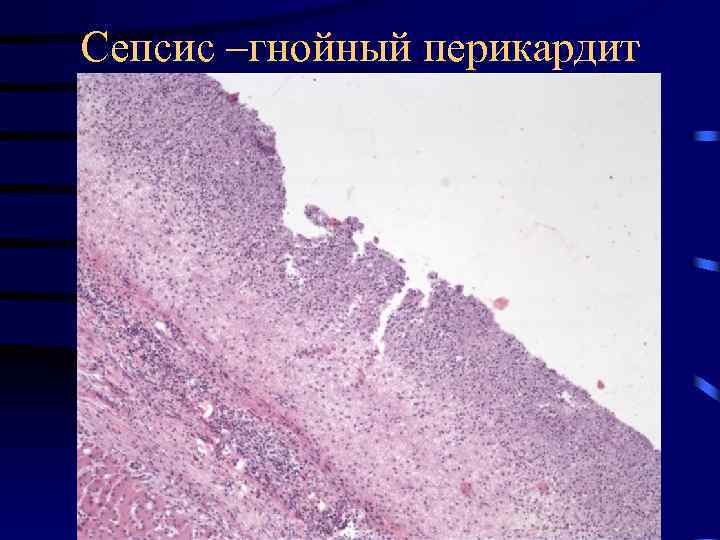 Сепсис –гнойный перикардит 