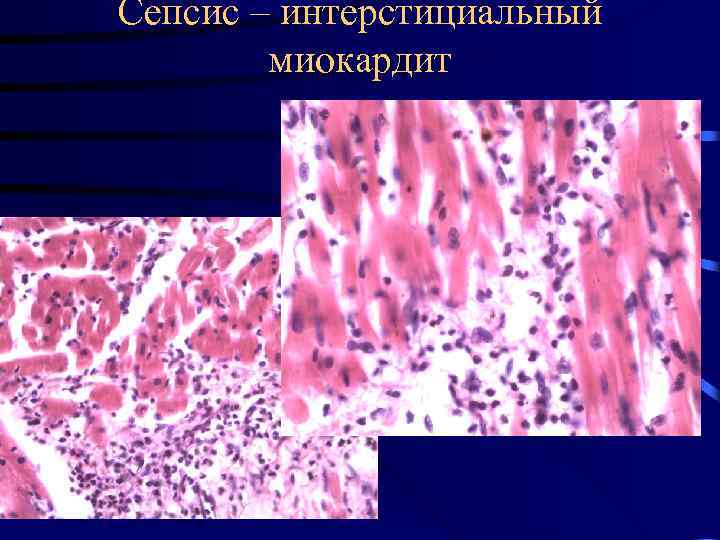 Сепсис – интерстициальный миокардит 