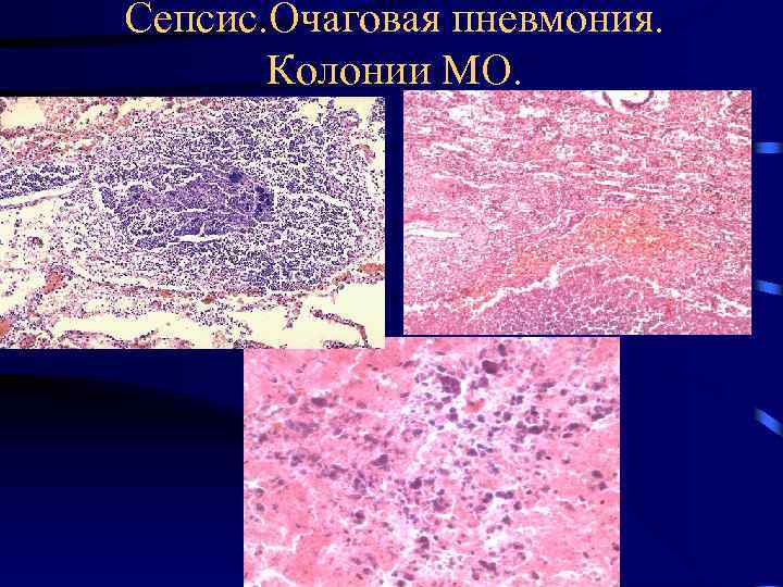 Сепсис. Очаговая пневмония. Колонии МО. 