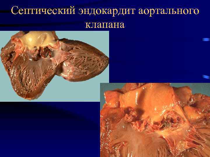 Септический эндокардит аортального клапана 
