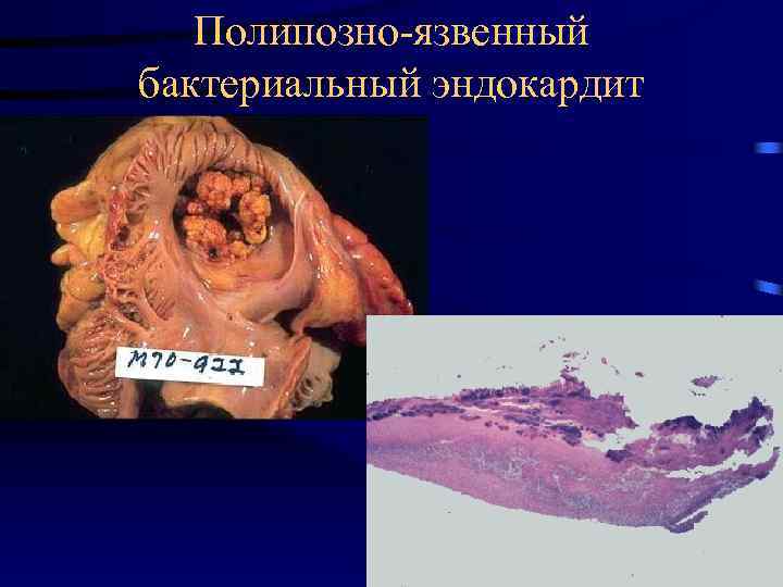 Полипозно-язвенный бактериальный эндокардит 