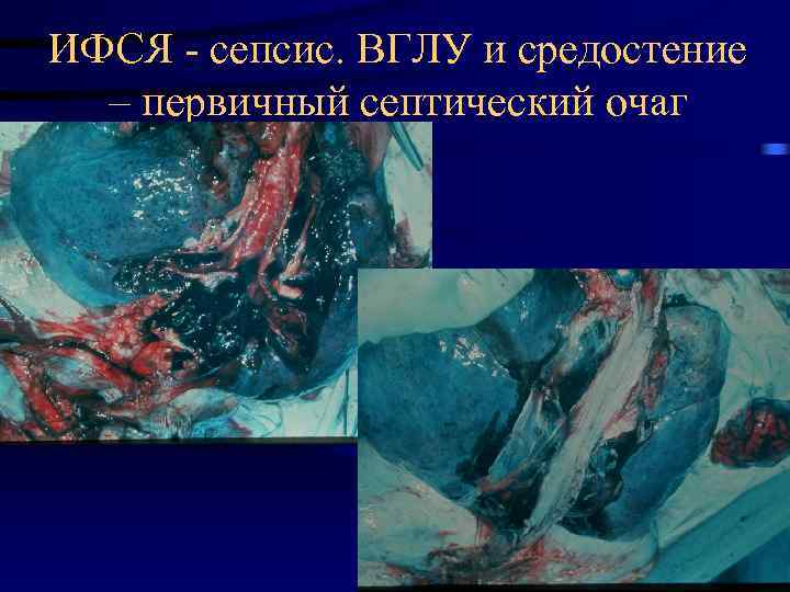 ИФСЯ - сепсис. ВГЛУ и средостение – первичный септический очаг 