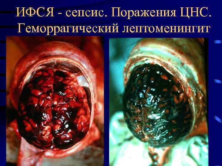 ИФСЯ - сепсис. Поражения ЦНС. Геморрагический лептоменингит 
